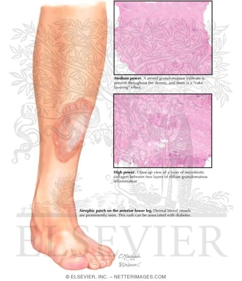 Necrobiosis Lipoidica