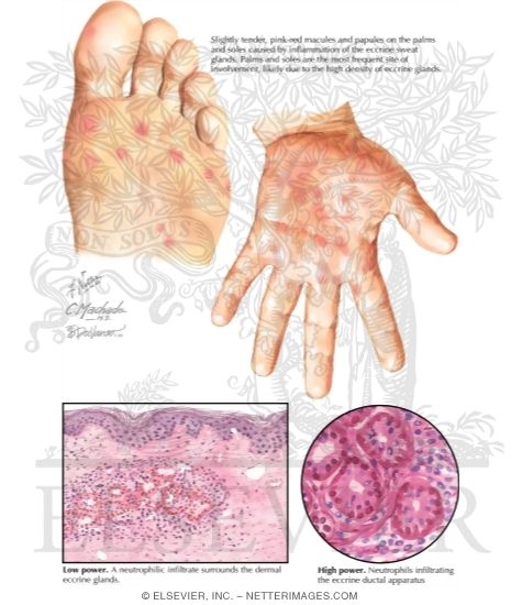 Neutrophilic Eccrine Hidradenitis