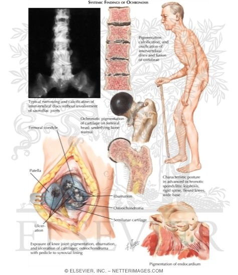 Watermarked preview of labeled image: Ochronosis