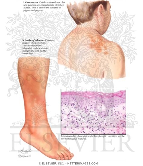 Pigmented Purpura