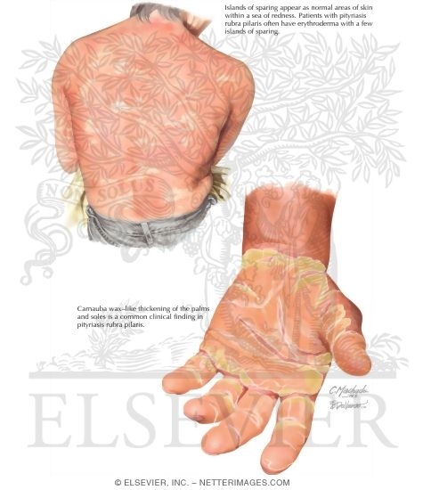 Pityriasis Rubra Pilaris