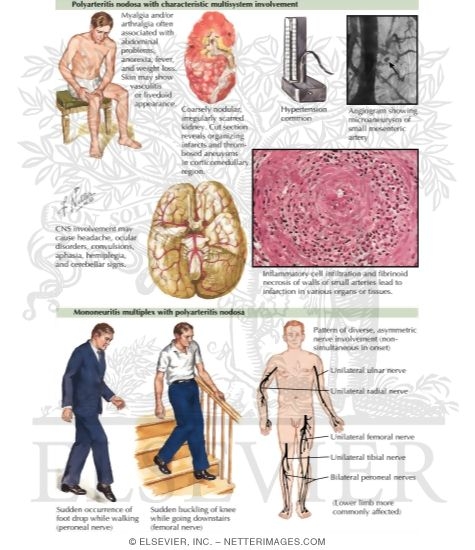 Polyarteritis Nodosa (PAN)