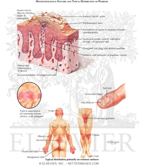 Watermarked preview of labeled image: Psoriasis