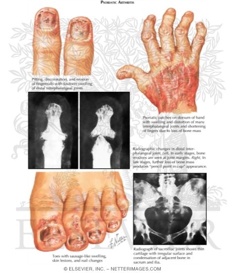 Psoriatic Arthritis