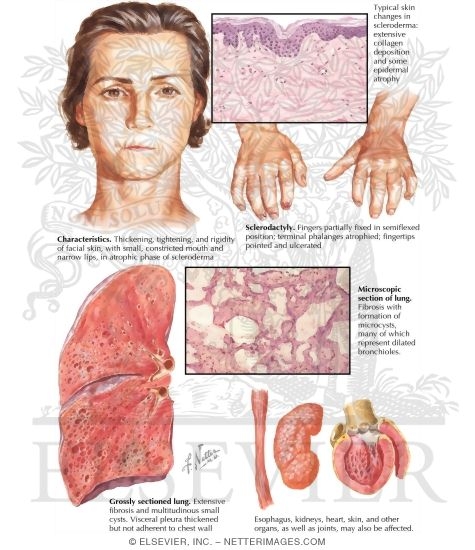 Scleroderma (Progressive Systemic Sclerosis)