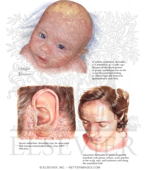 Seborrheic Dermatitis