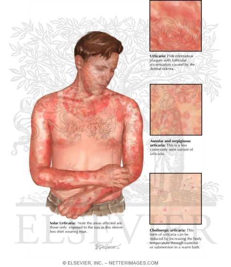 Watermarked preview of labeled image: Urticaria