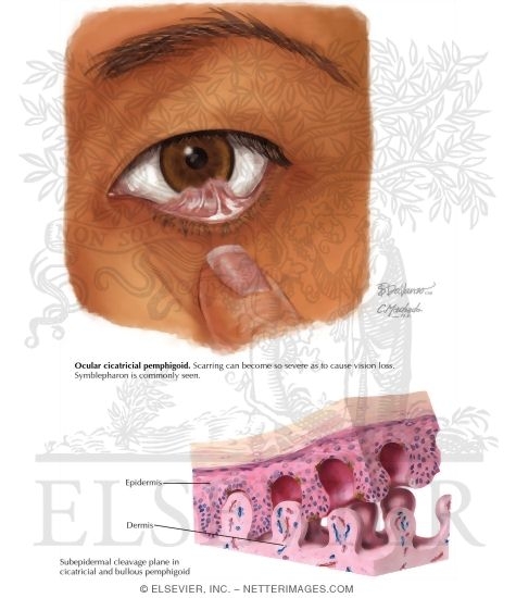 Watermarked preview of labeled image: Mucous Membrane Pemhigoid