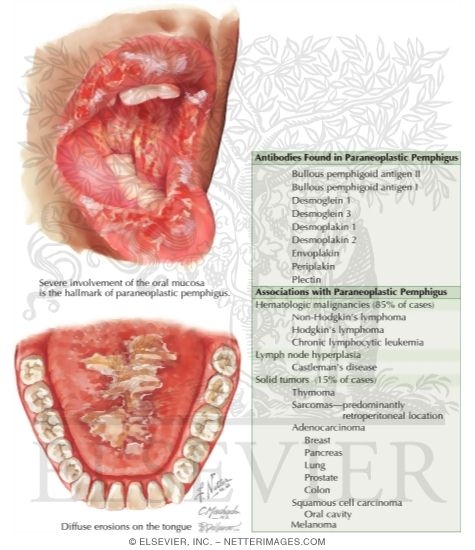 Watermarked preview of labeled image: Paraneoplastic Pemphigus