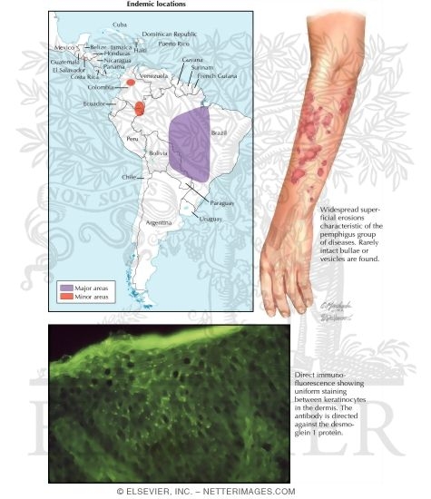 Pemphigus Foliaceous