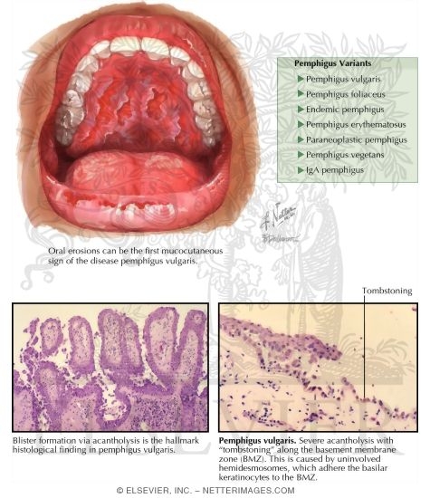 Watermarked preview of labeled image: Pemphigus Vulgaris