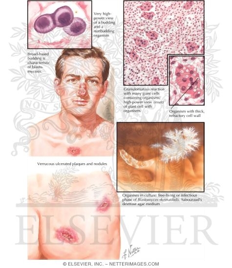 North American Blastomycosis