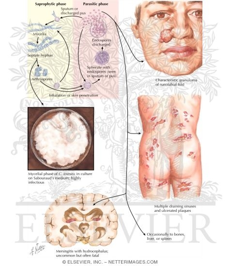 Coccidiodomycosis