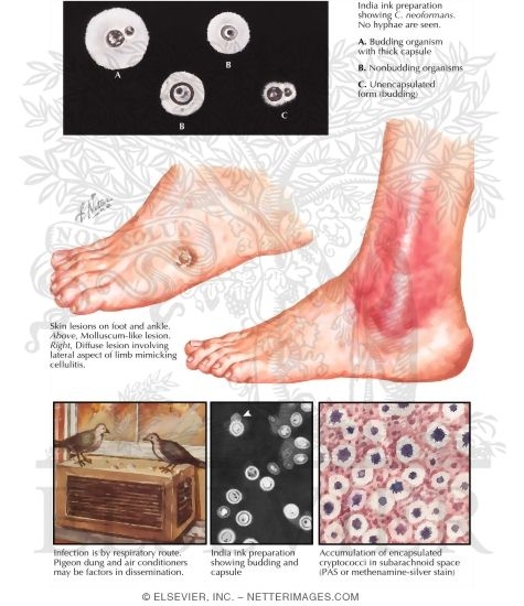Watermarked preview of labeled image: Cryptococcosis