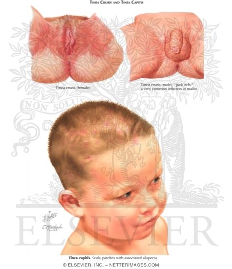 Dermatophytoses (Continued)