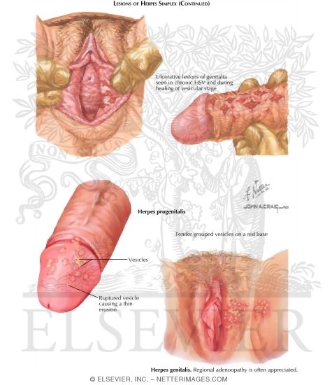 Herpes Pictures - Herpes & Cold Sores Support Network