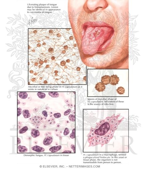 Histoplasmosis