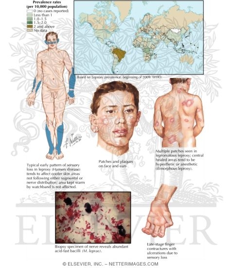 Watermarked preview of labeled image: Leprosy (Hansen's Disease)