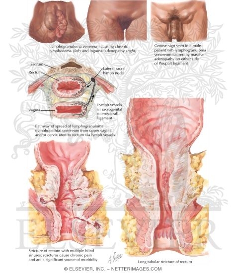 Lymphogranuloma Venereum