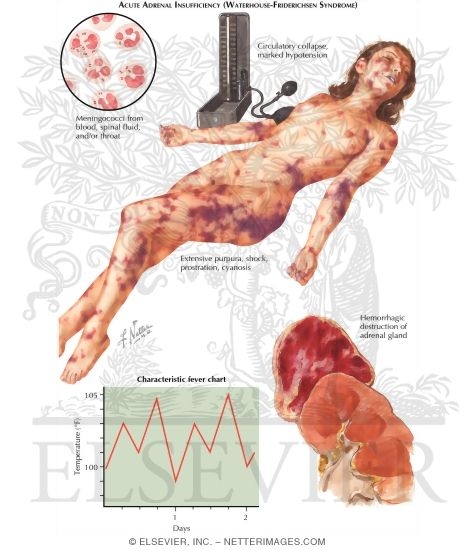 Acute Adrenal Insufficiency (Waterhouse Friderichsen Syndrome)