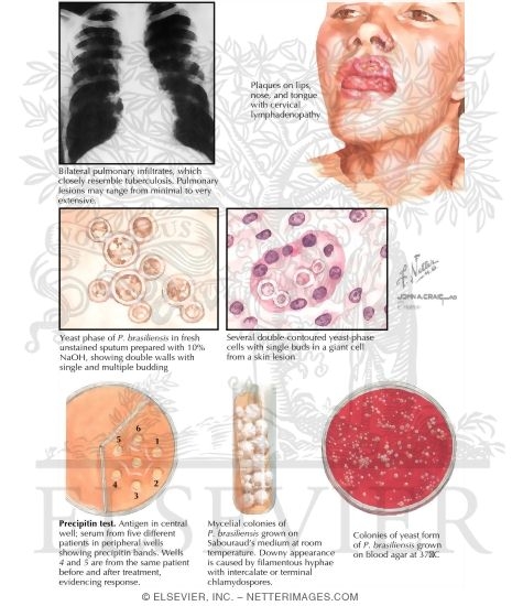 South American Blastomycosis