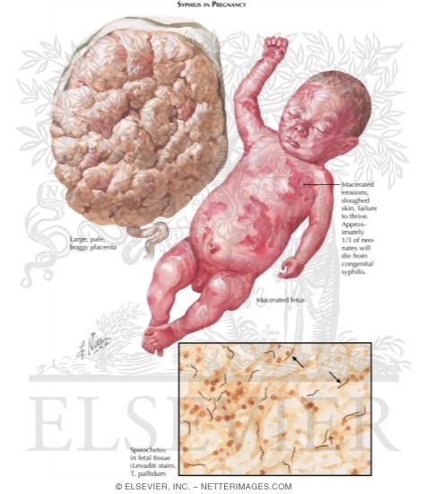 Watermarked preview of labeled image: Syphilis