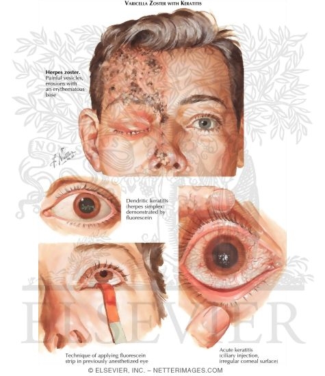 Keratits (Inflammation of the Cornea)