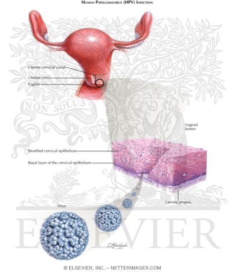 Watermarked preview of labeled image: Sexually Transmitted Infections: Human Papillomavirus (HPV)