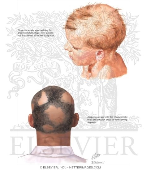 Alopecia Areata