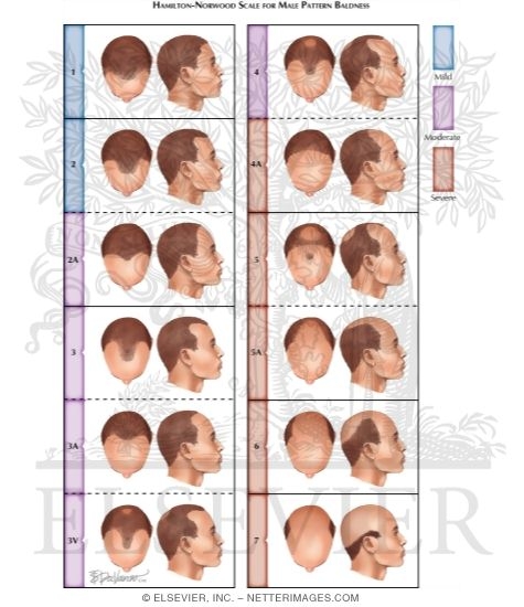 androgenetic alopecia under fontanacountryinn com androgenetic alopecia