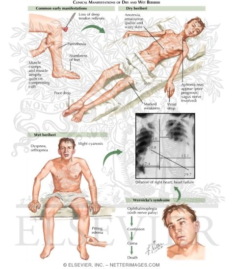 Vitamin B1 Deficiency: Beriberi