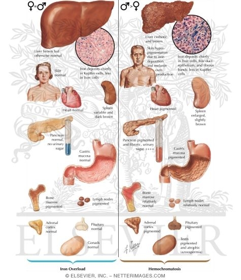 Hemosiderosis, Hemochromatosis: Normal Iron Metabolism