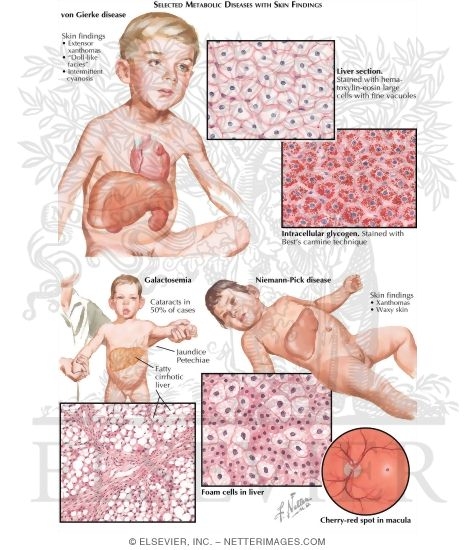 Watermarked preview of labeled image: Metabolic Injuries II - Gierke's Disease, Galactosemia, Niemann-Pick's Disease