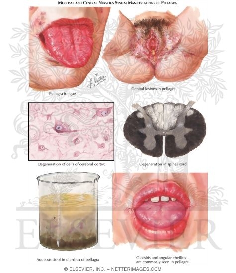 Watermarked preview of labeled image: Pellagra