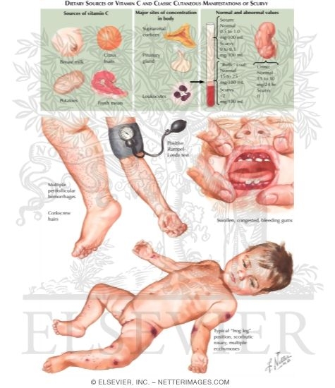 Watermarked preview of labeled image: Vitamin C Deficiency (Scurvy)