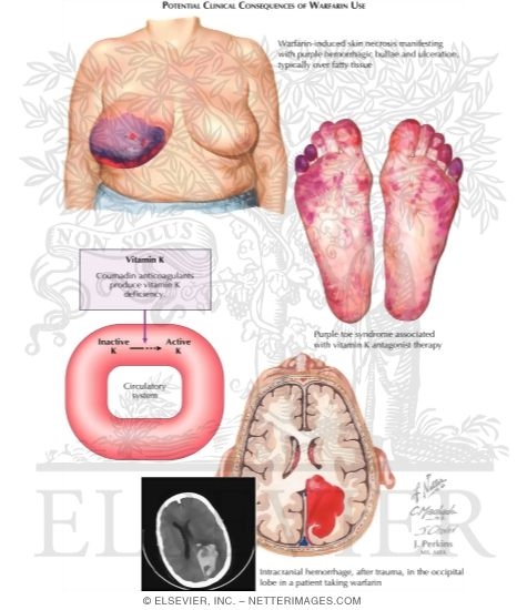 Vitamin K Deficiency & Vitamin K Antagonists