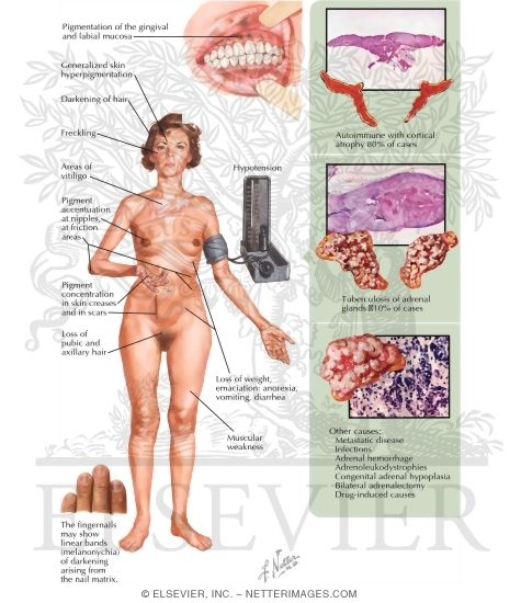 Watermarked preview of labeled image: Chronic Primary Adrenal Failure: Addison's Disease