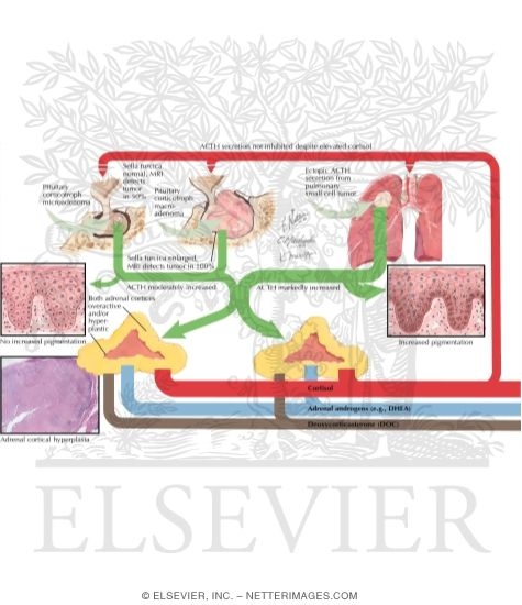 Cushing's Syndrome: Pathophysiology