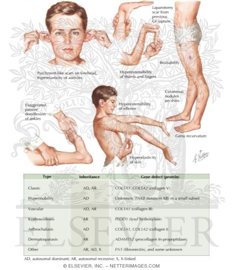 Ehlers-Danlos Syndrome