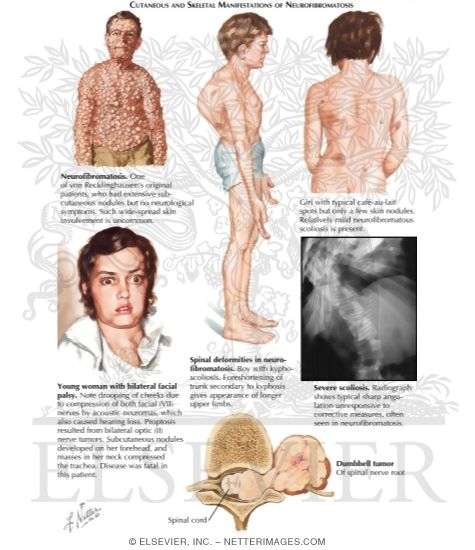 Neurofibromatosis (Continued)