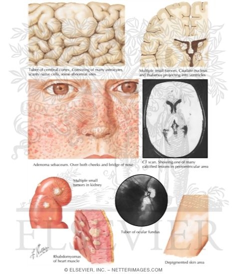Tuberous Sclerosis