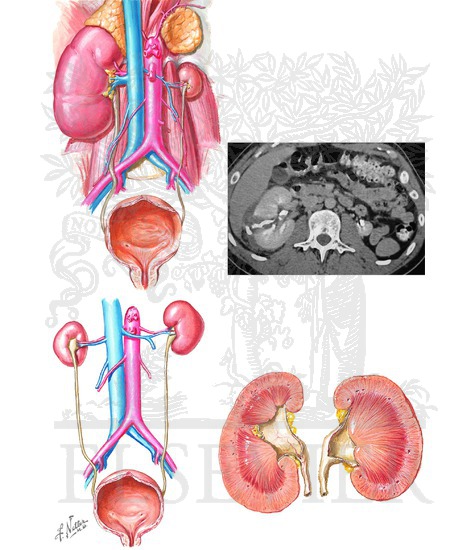 Renal Hypoplasia