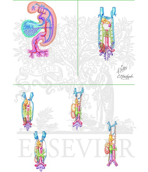Retrocaval Ureter: Normal Development of the Inferior Vena Cava