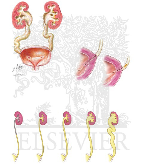 Vesicoureteral Reflex: Mechanism and Grading