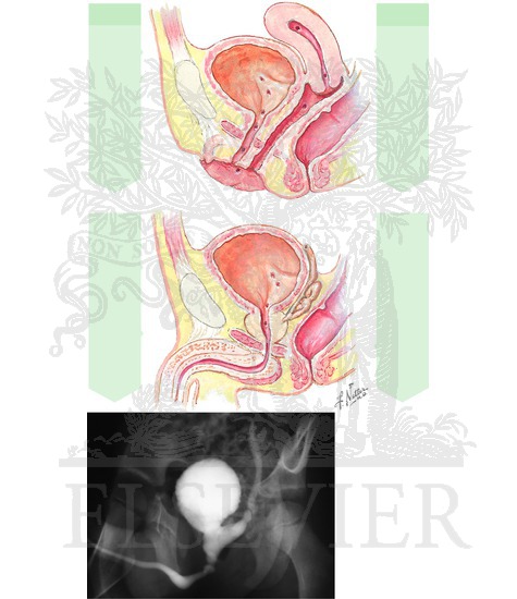 Watermarked preview of unlabeled image: Ectopic Ureter