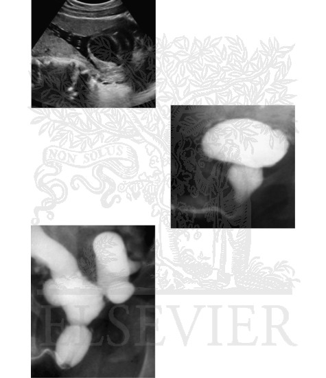 Posterior Urethral Valves: Radiographic Findings