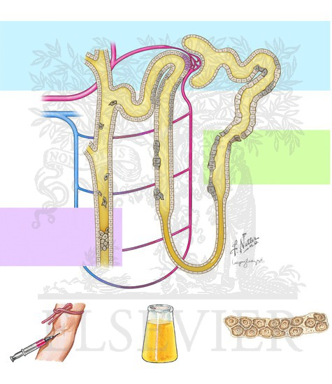 Acute Tubular Necrosis: Causes, Pathophysiology, and Clinical Features