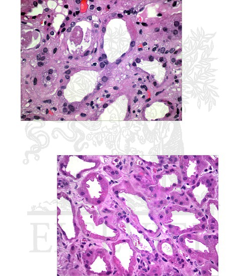 Watermarked preview of unlabeled image: Acute Tubular Necrosis: Histopathologic