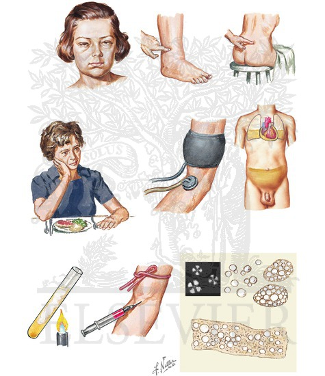 Overview of Nephrotic Syndrome: Presentation and Diagnosis