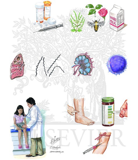 Minimal Change Disease: Causes and Presentation